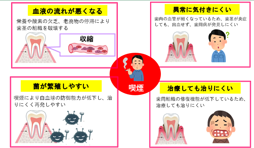 タバコと歯周病の関係