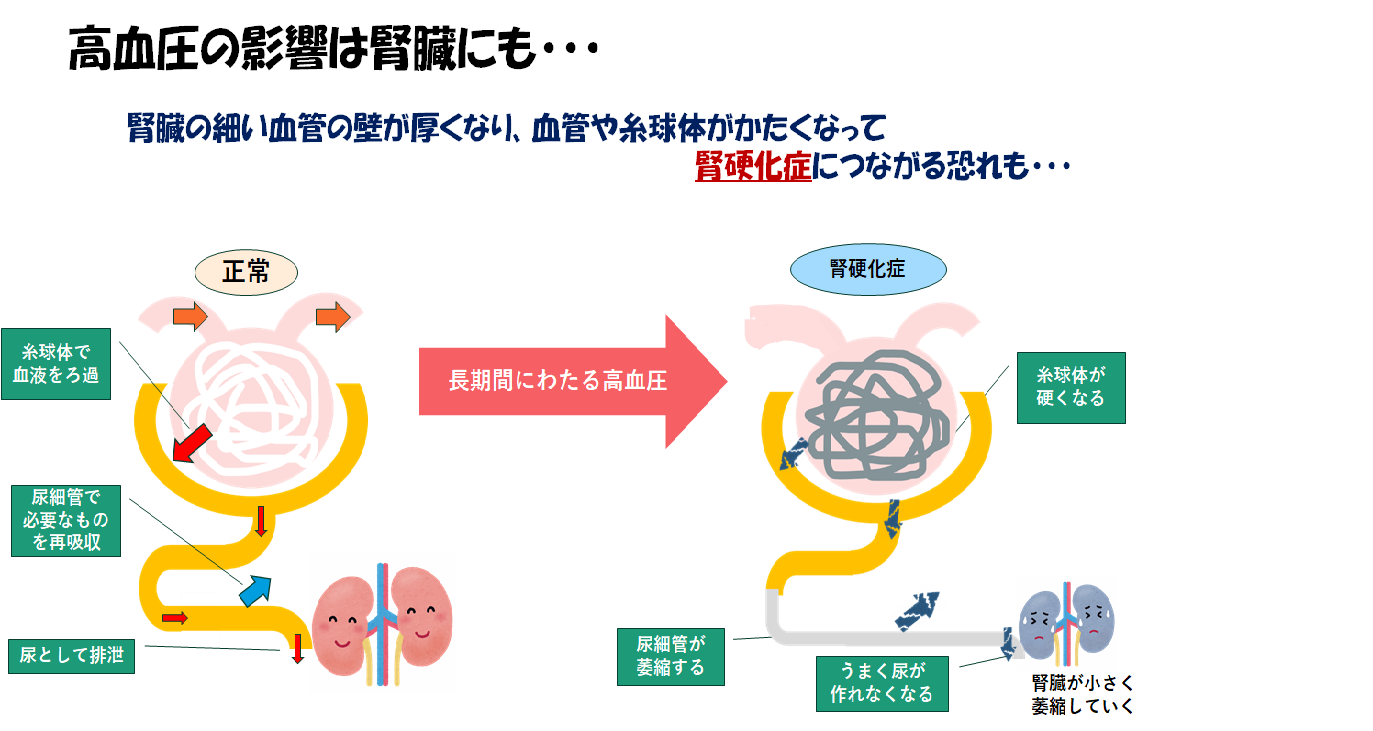 腎硬化症