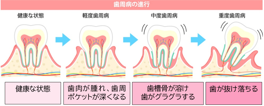 歯周病の進行