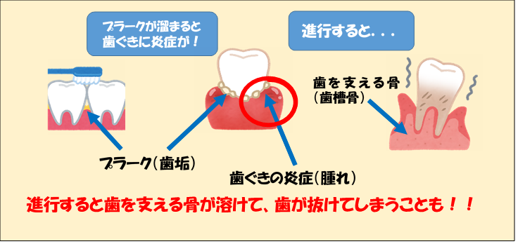 歯周病の進行(最新版)